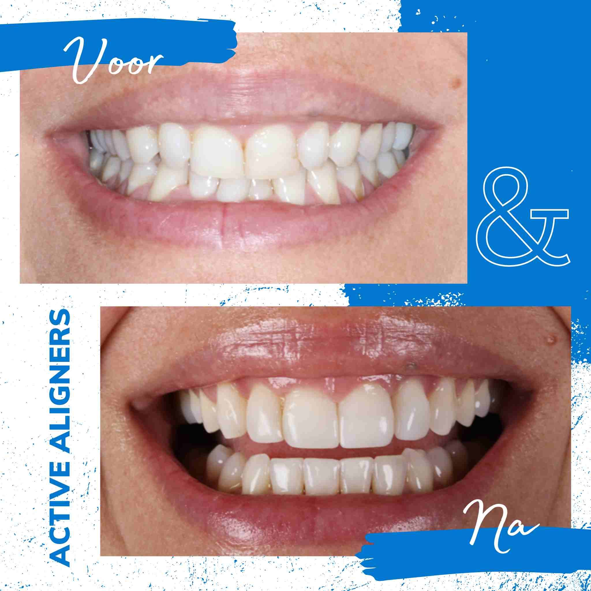 Active Aligners Before and After Pic