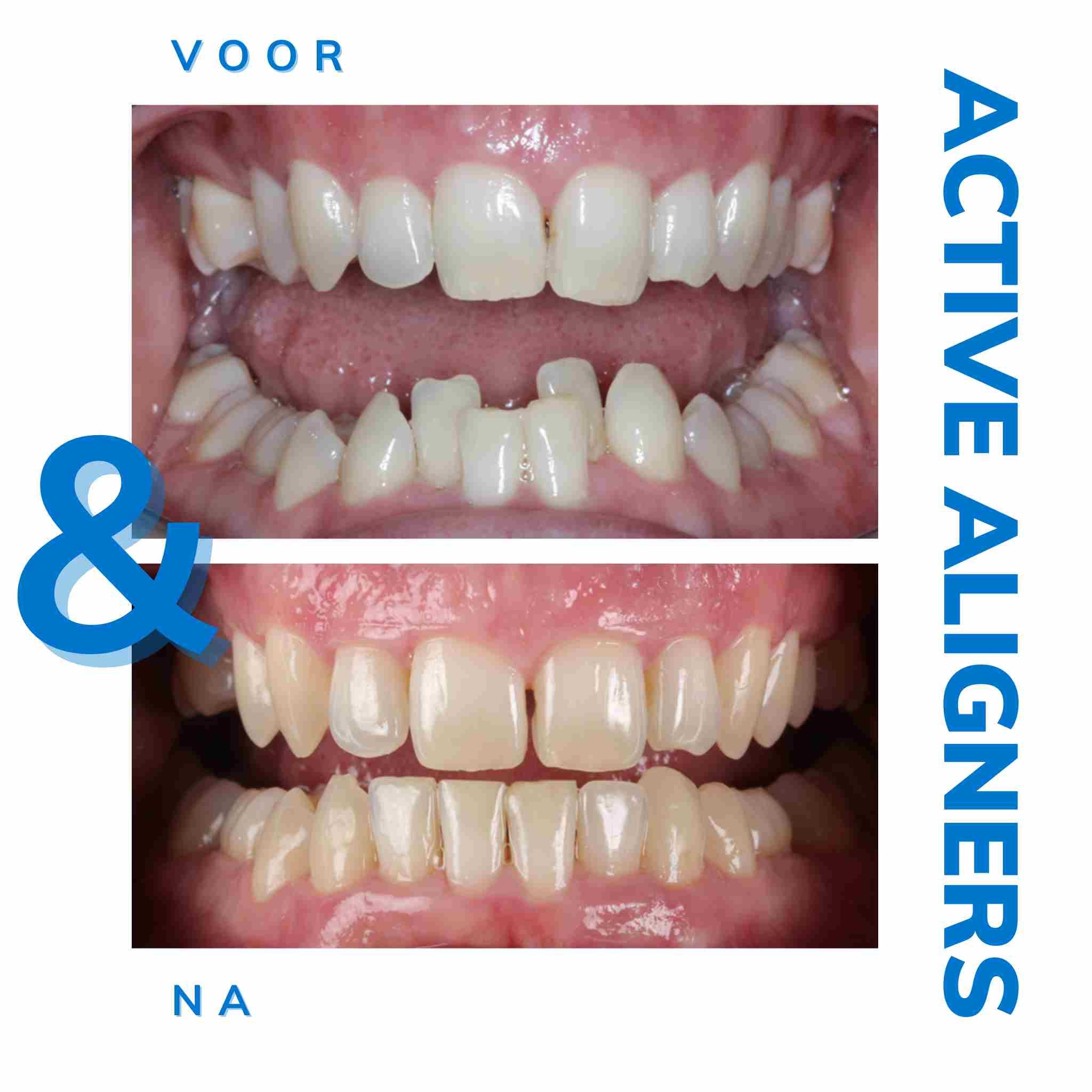 Active Aligners Before and after pic