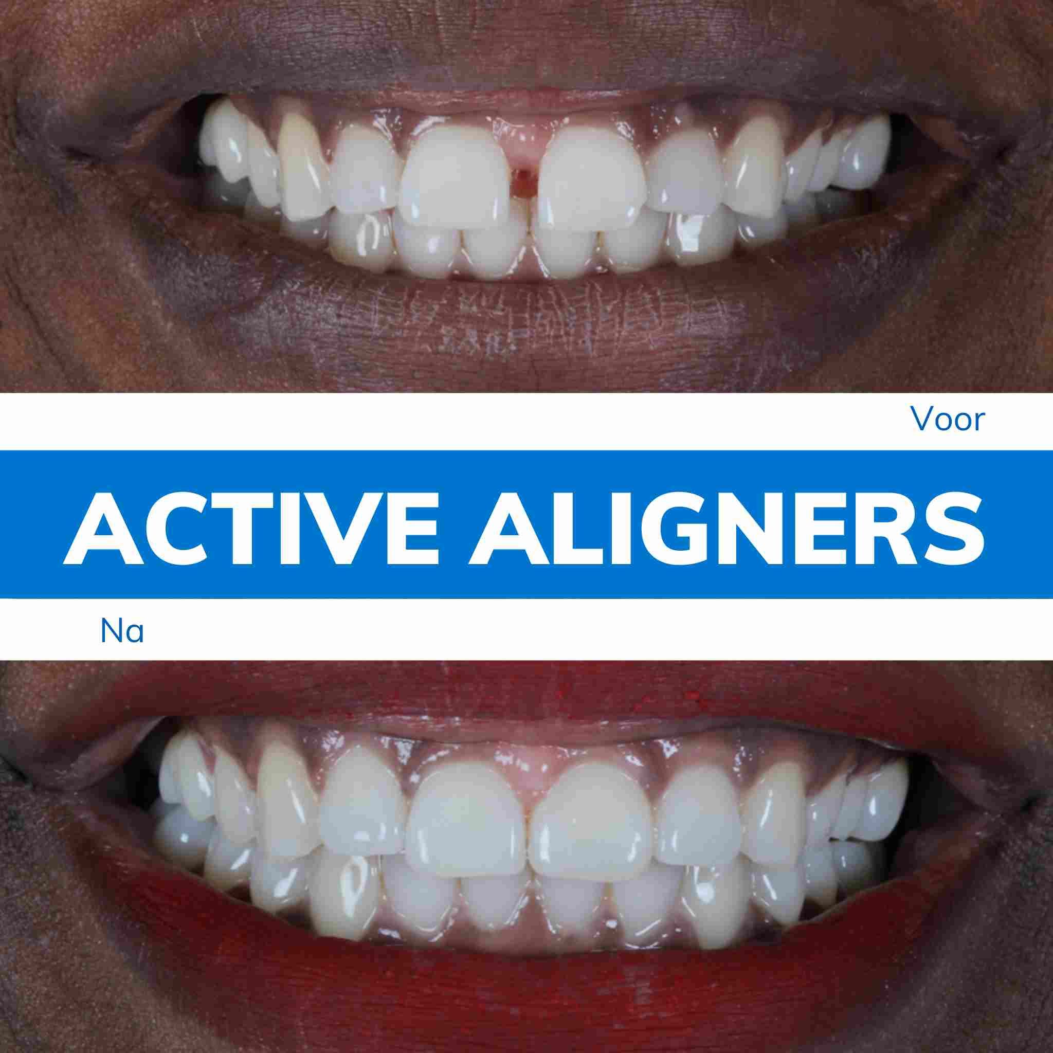 Active Aligners Before and after pic