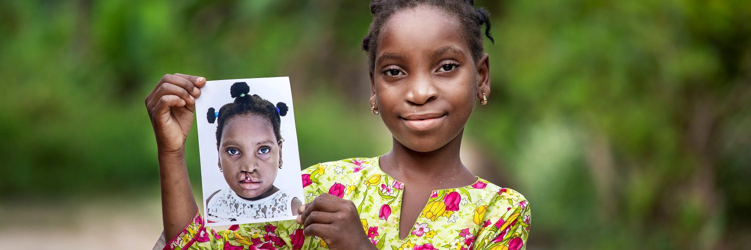 An Operation Smile South Africa patient, smiling after treatment