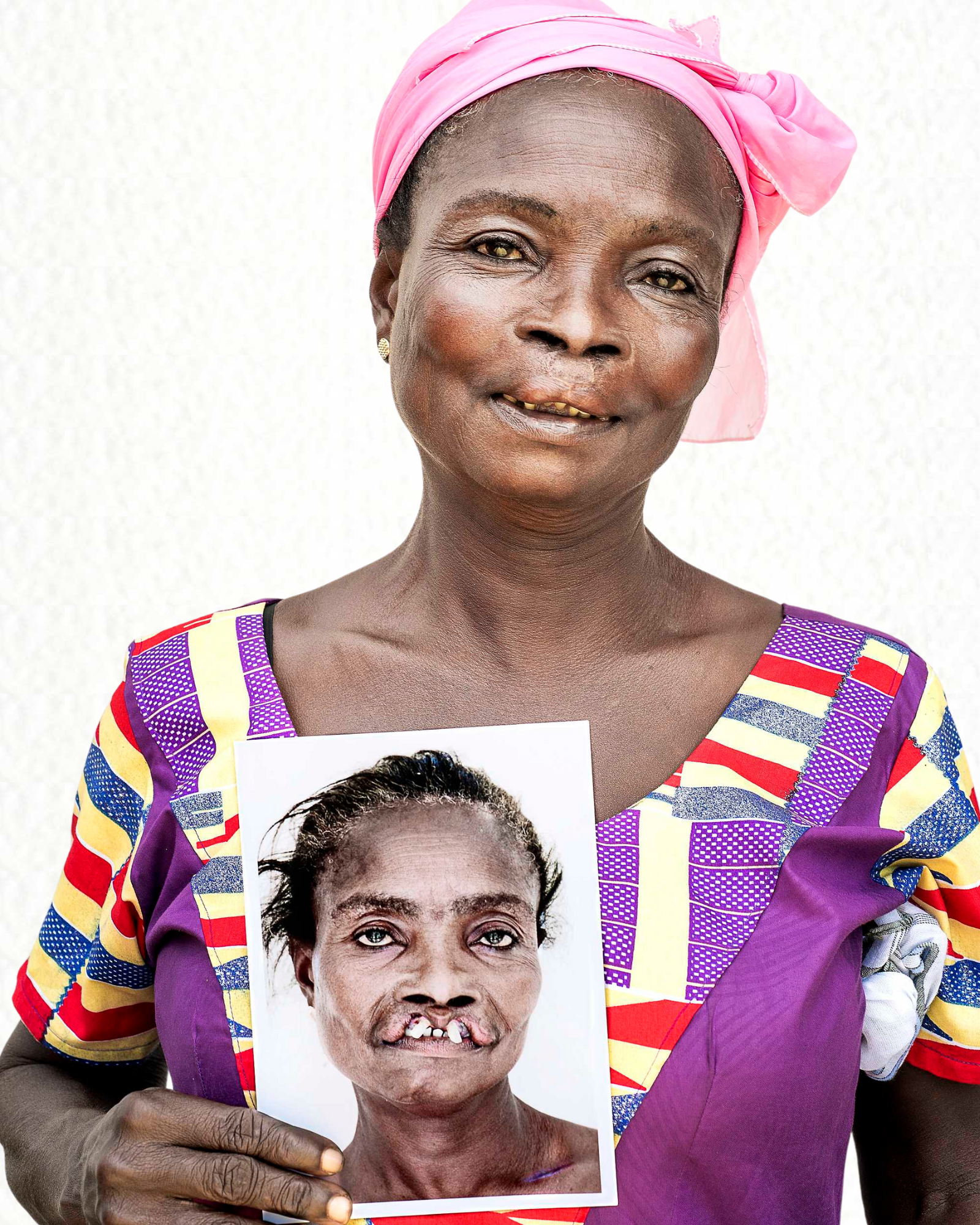 Akosua, an Operation Smile South Africa patient