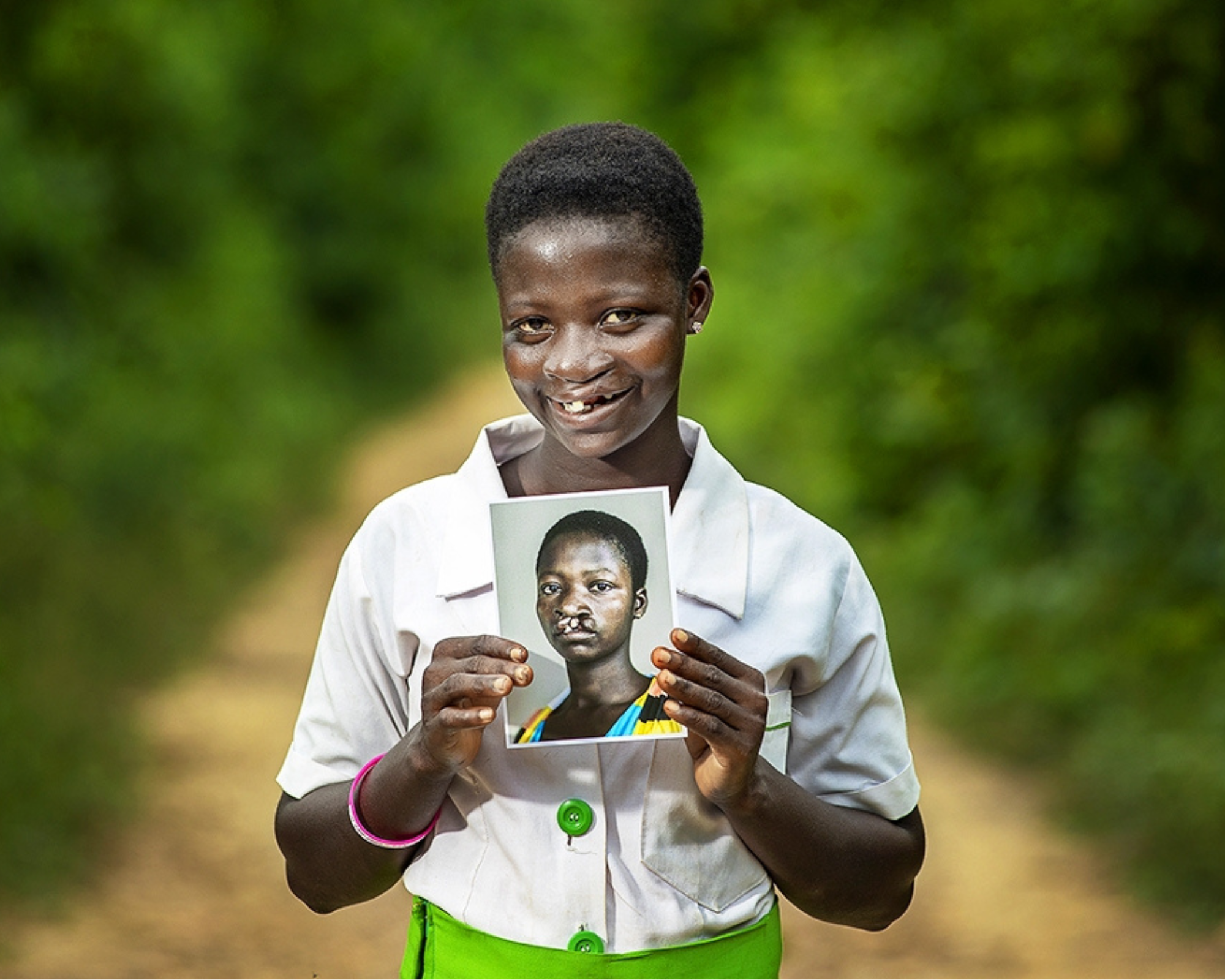 Faustina, an Operation Smile South Africa patient