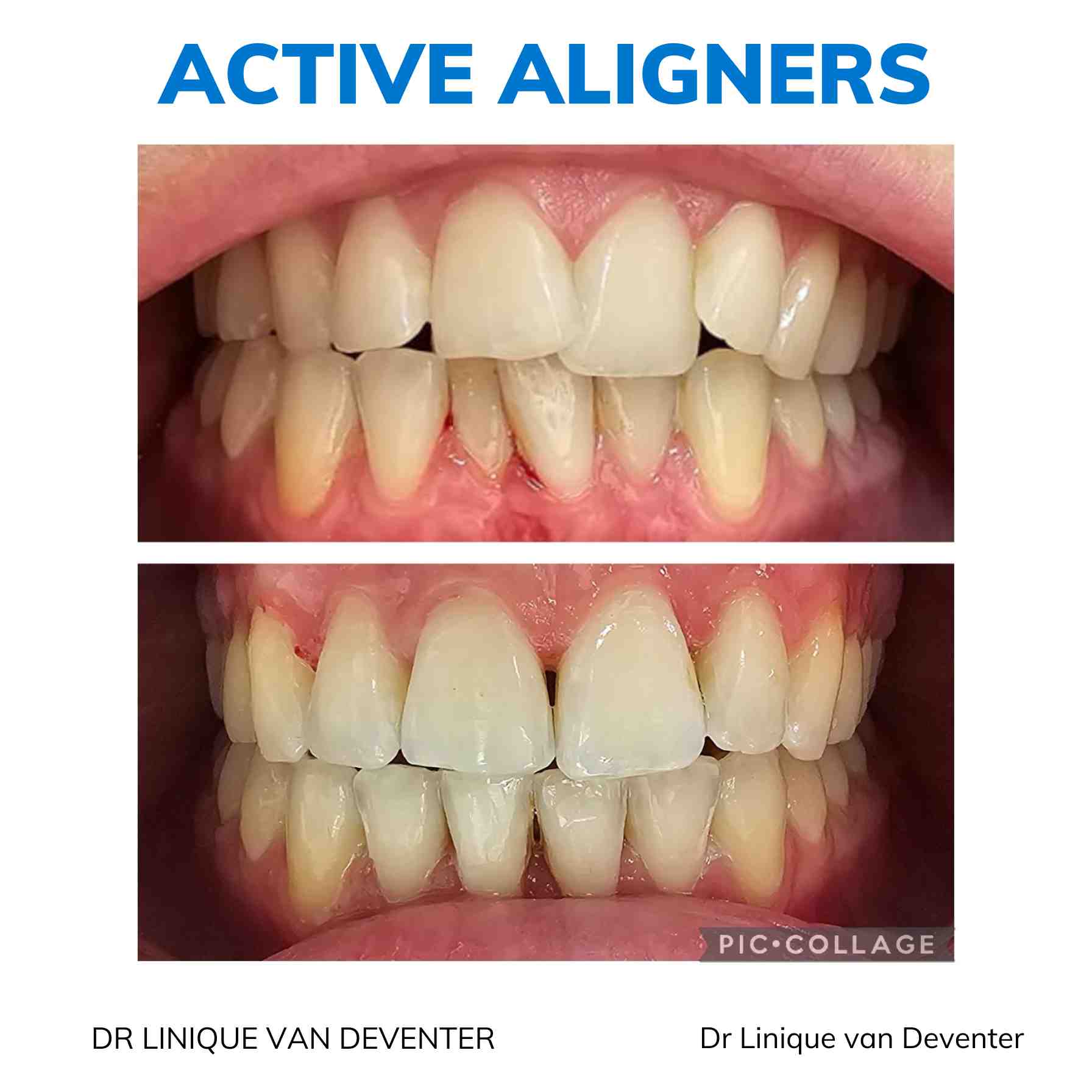 Active Aligners clear aligners before and after, real dentist-delivered case 1
