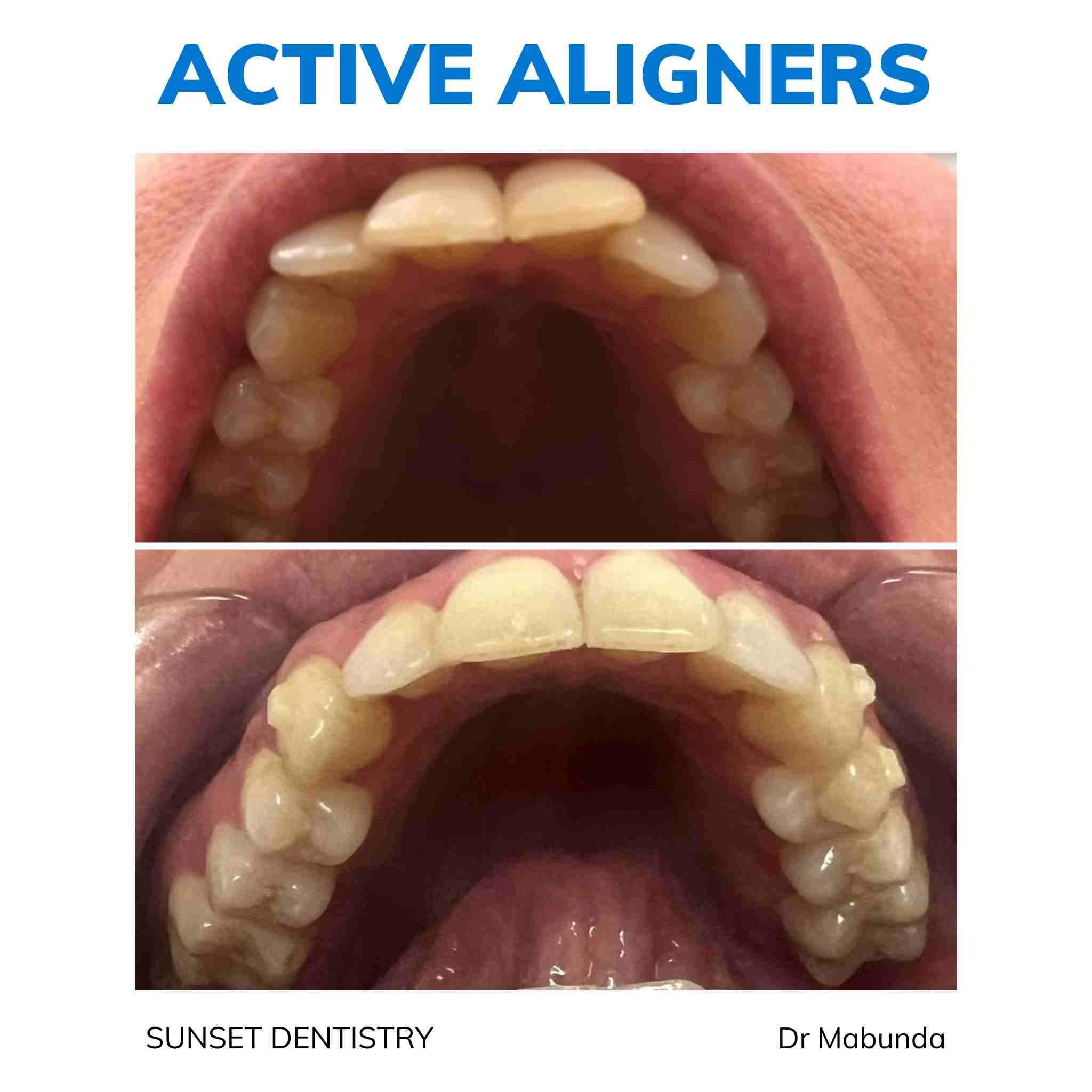 Active Aligners clear aligners before and after, real dentist-delivered case 2