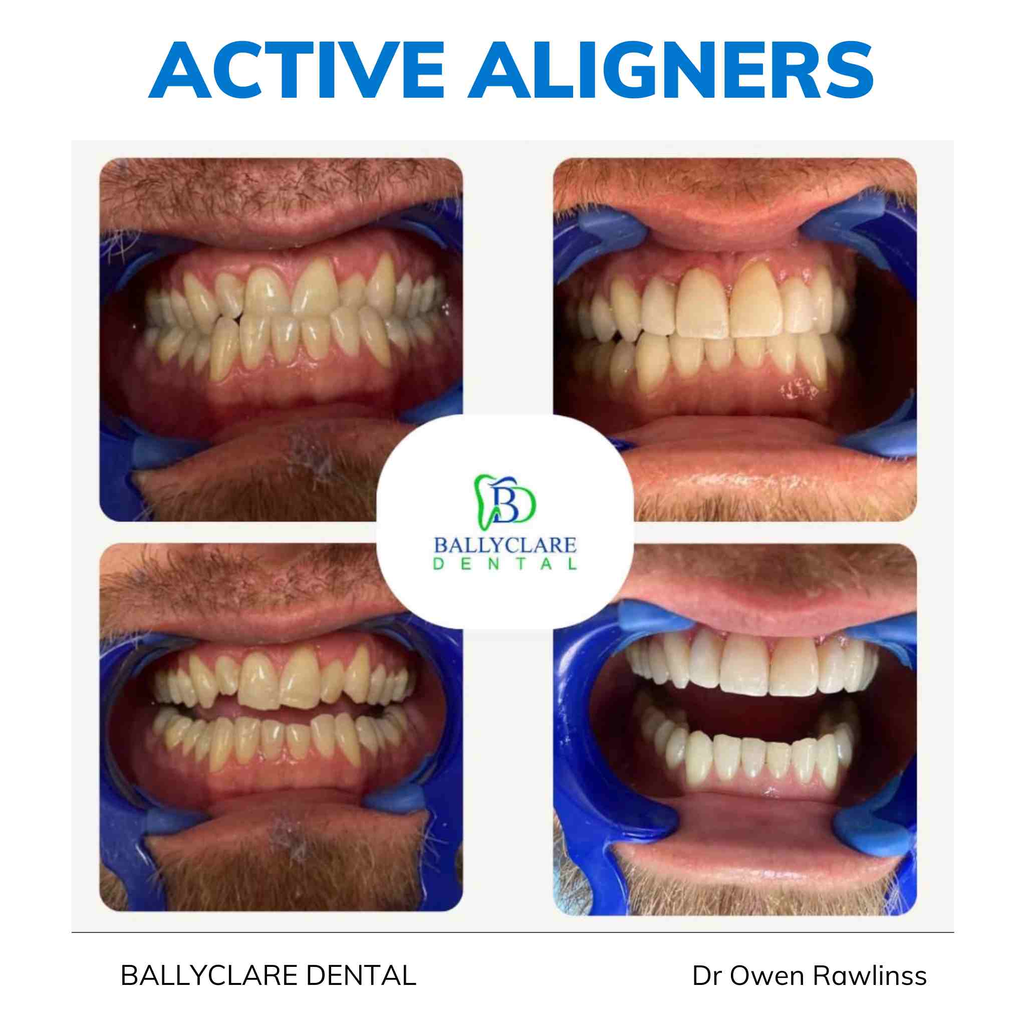 Active Aligners clear aligners before and after, real dentist-delivered case 3