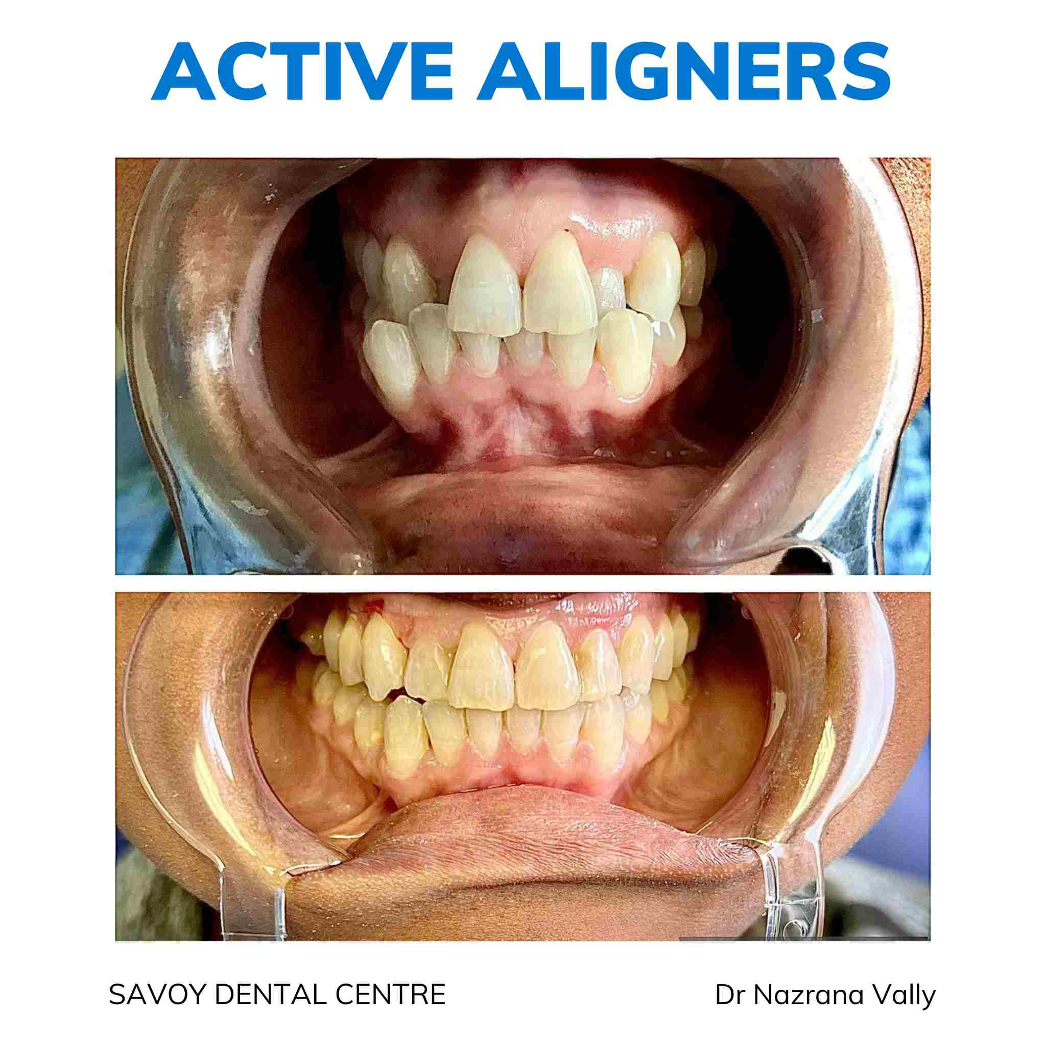 Active Aligners clear aligners before and after, real dentist-delivered case 4