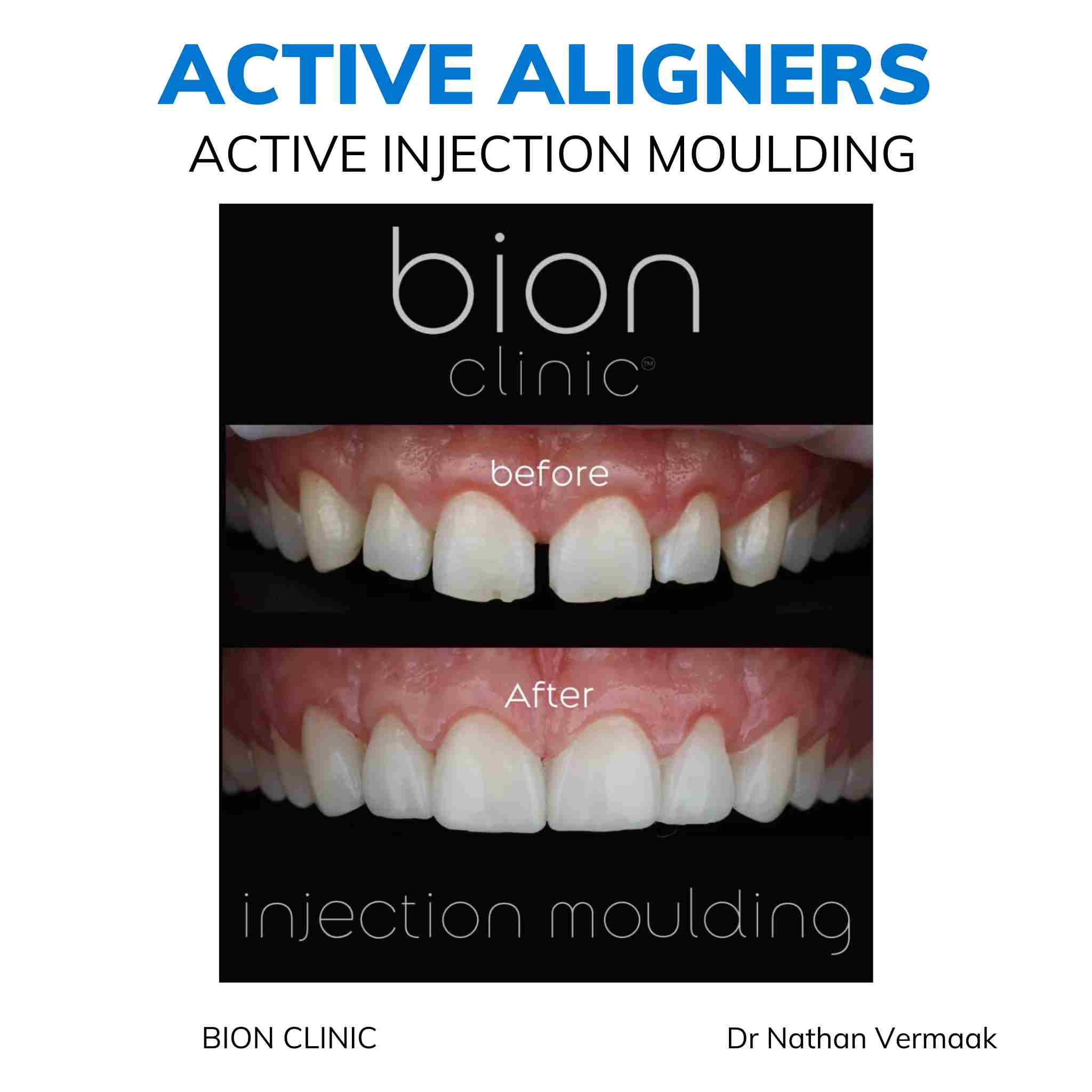 Active Aligners clear aligners before and after, real dentist-delivered case 5