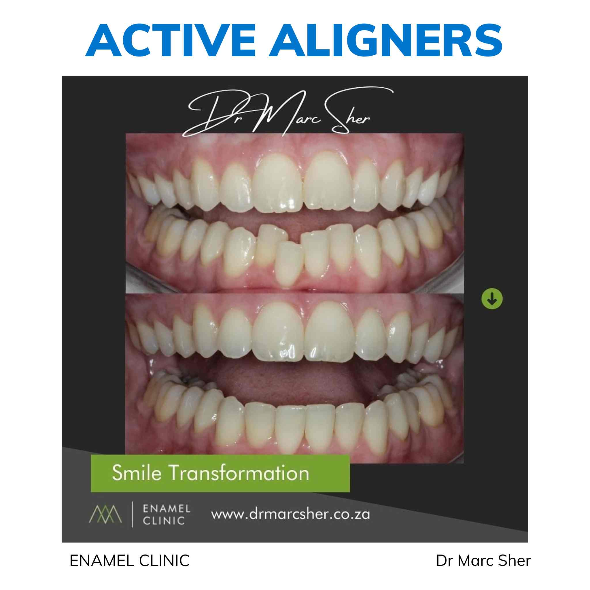 Active Aligners clear aligners before and after, real dentist-delivered case 6