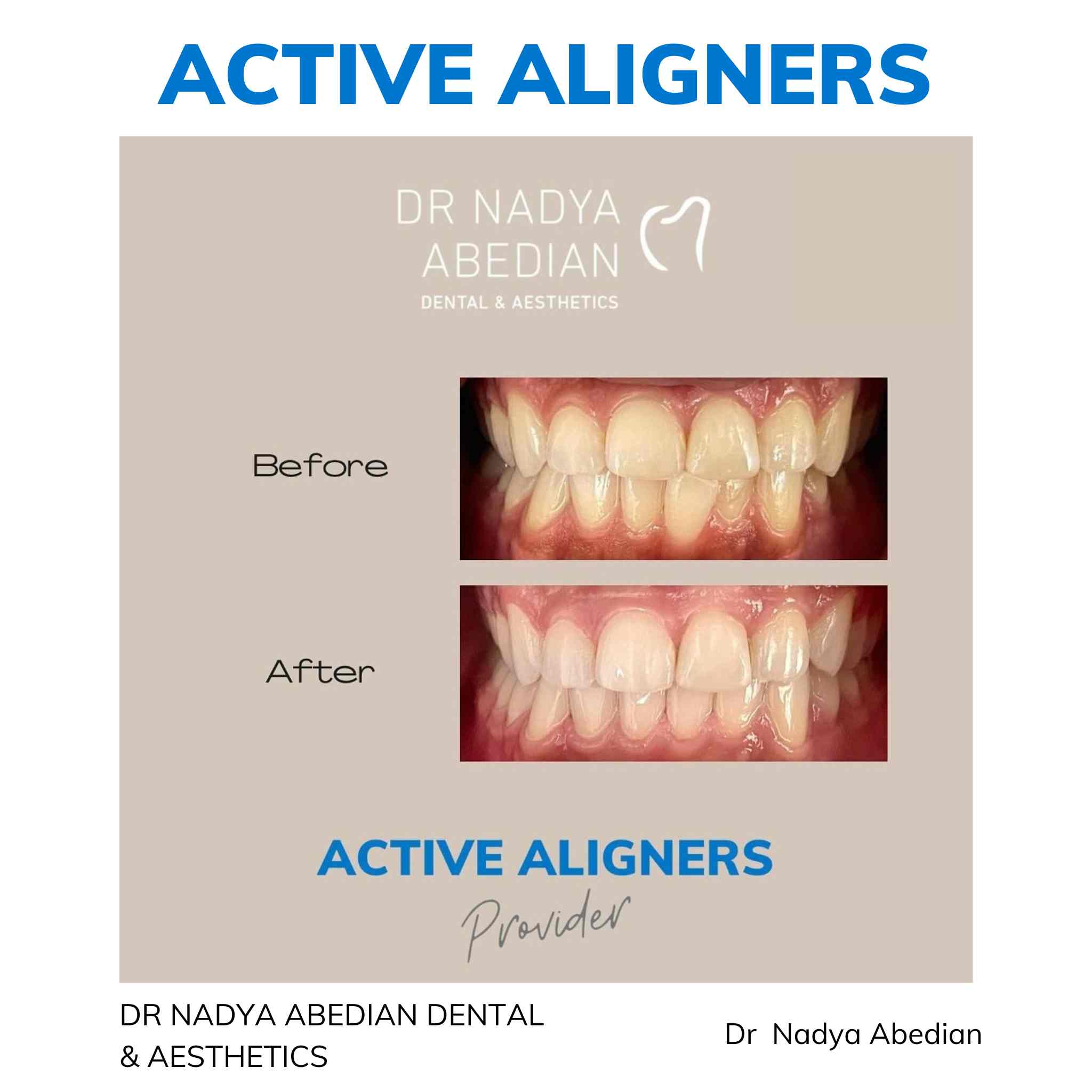 Active Aligners clear aligners before and after, real dentist-delivered case 7