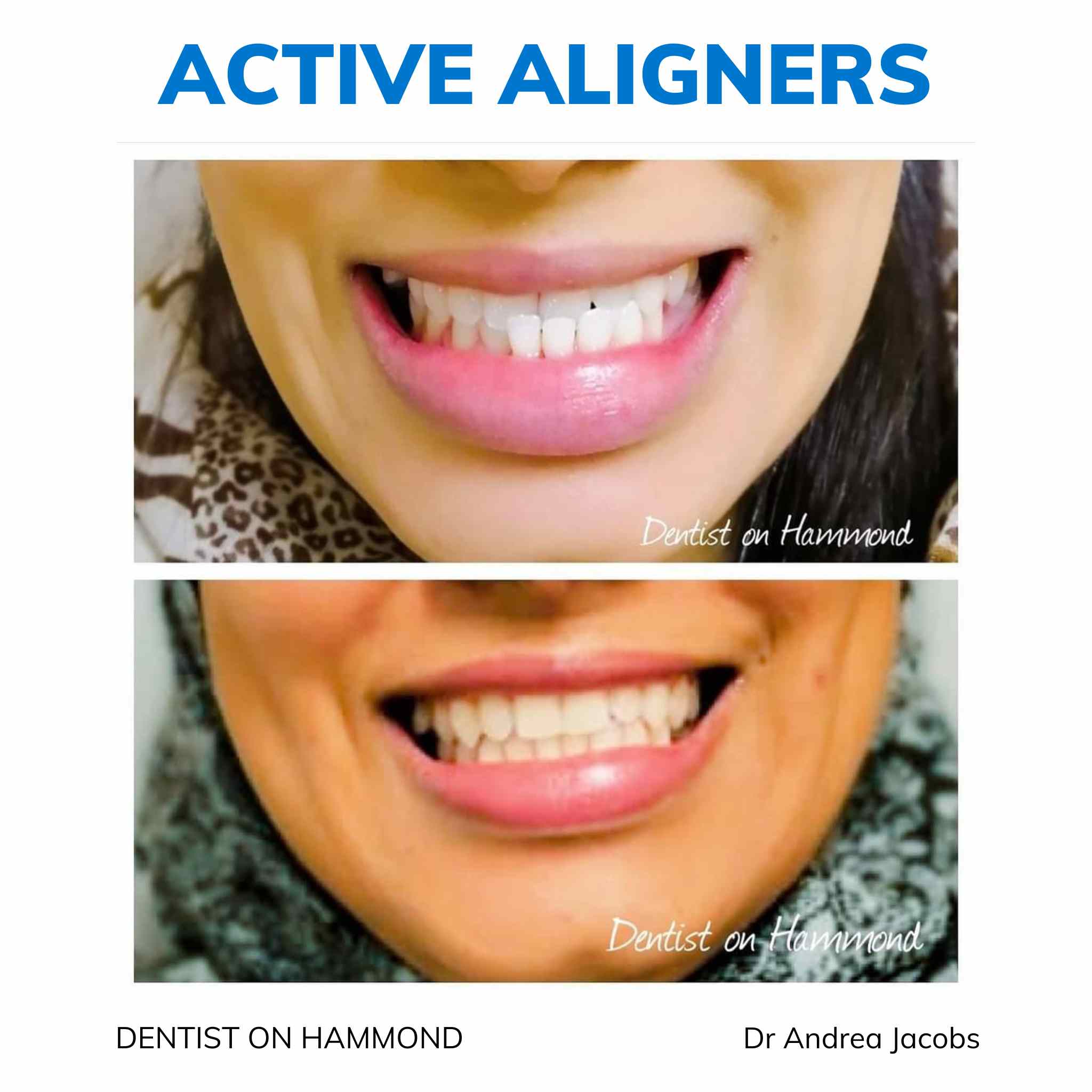 Active Aligners clear aligners before and after, real dentist-delivered case 8