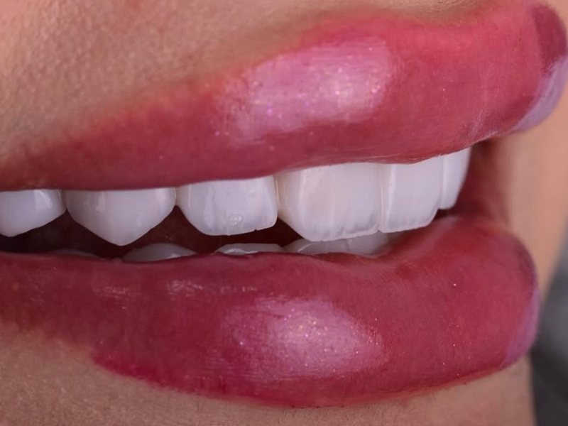 Smile Club Veneers result, natural translucency and lifelike finish