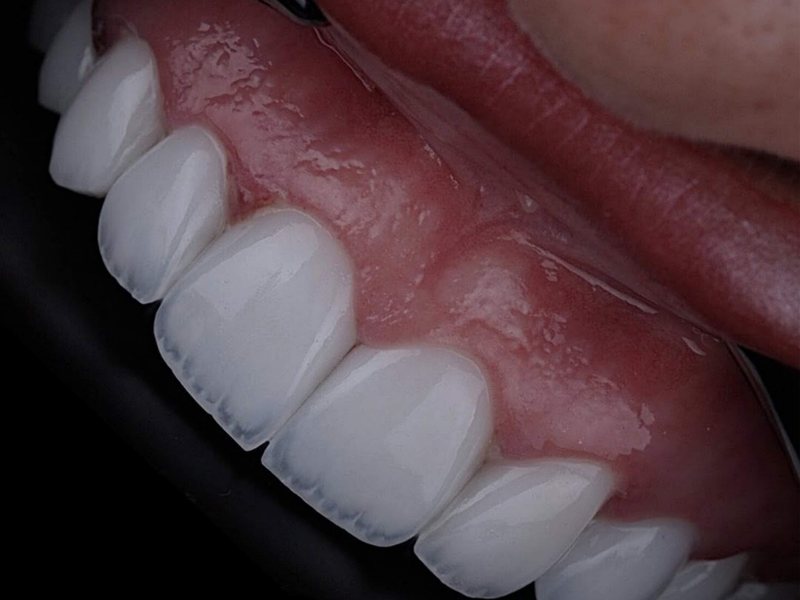 Smile Club Veneers result, even shade and lifelike edges