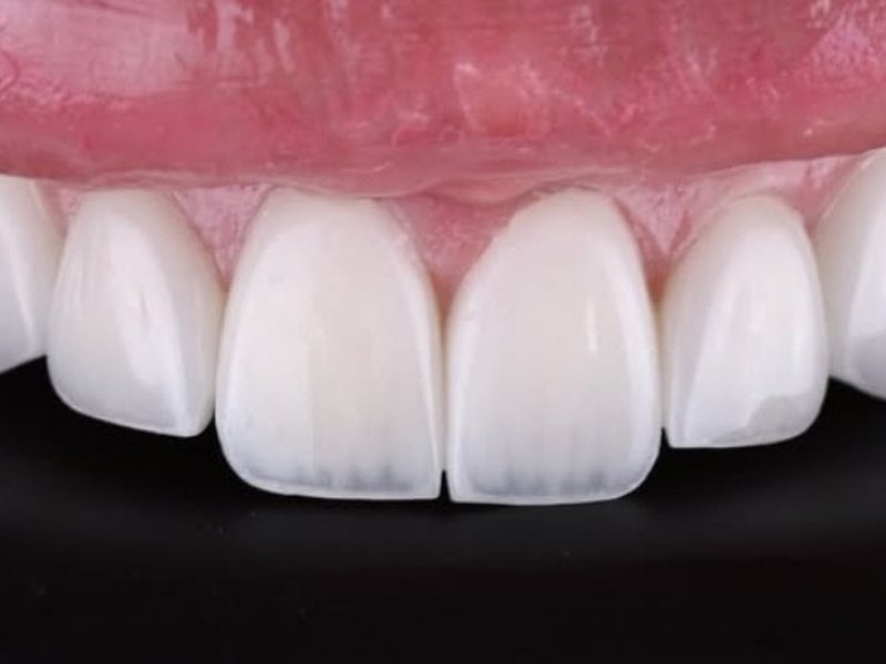 Smile Club Veneers porcelain veneer result, clean margins