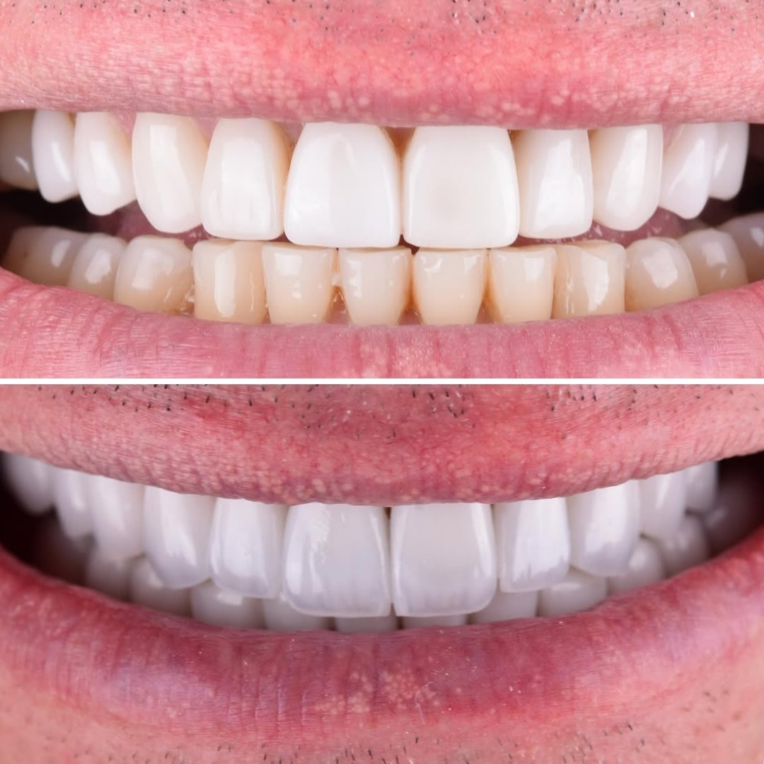 Smile Club Veneers before and after, worn edges restored, shade evened