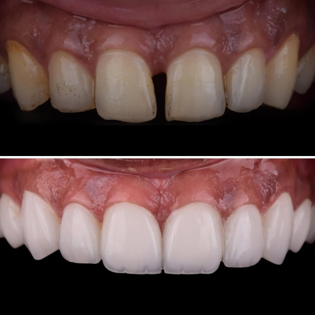 Smile Club Veneers before and after, diastema gap closure, spacing and balance