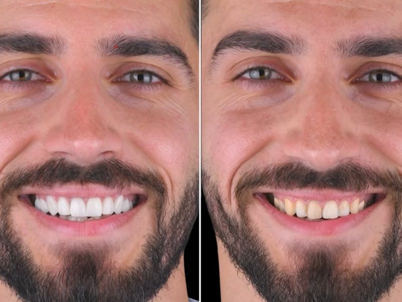 Smile Club Veneers before and after, male smile transformation