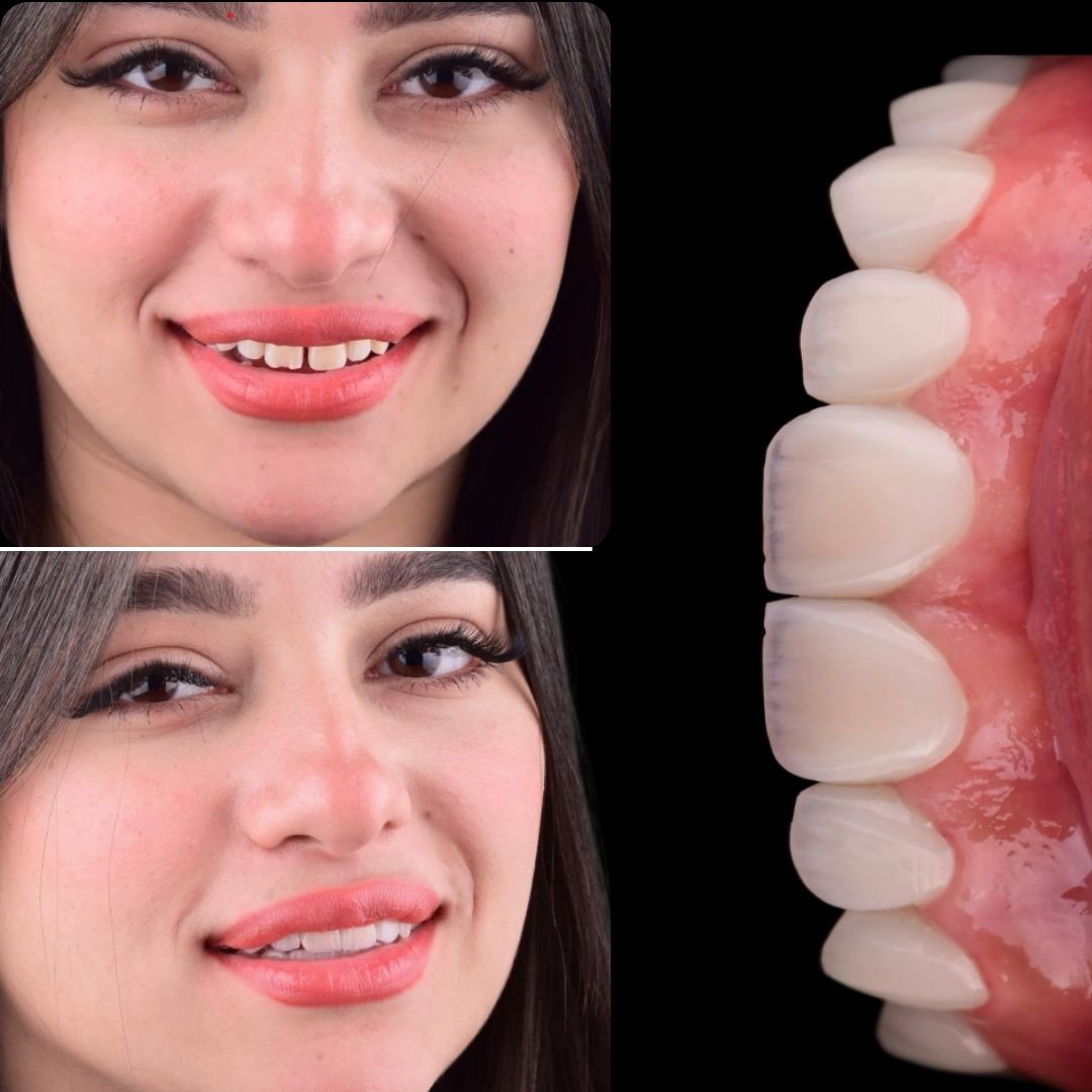 Smile Club Veneers before and after, porcelain veneer smile makeover