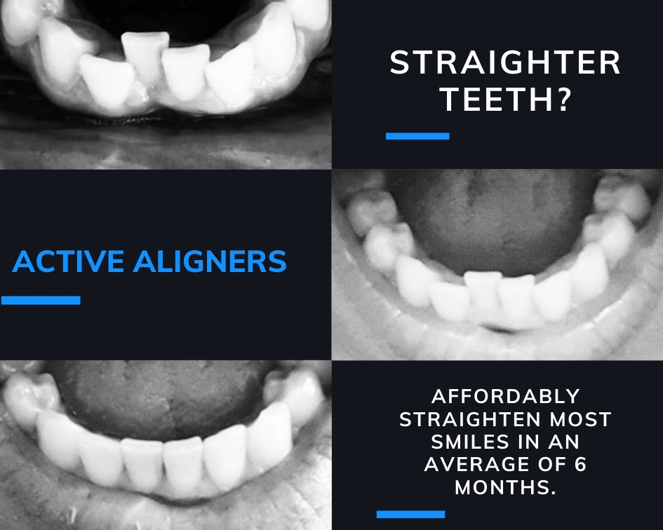 Top 7 Tips for Active Aligners Success