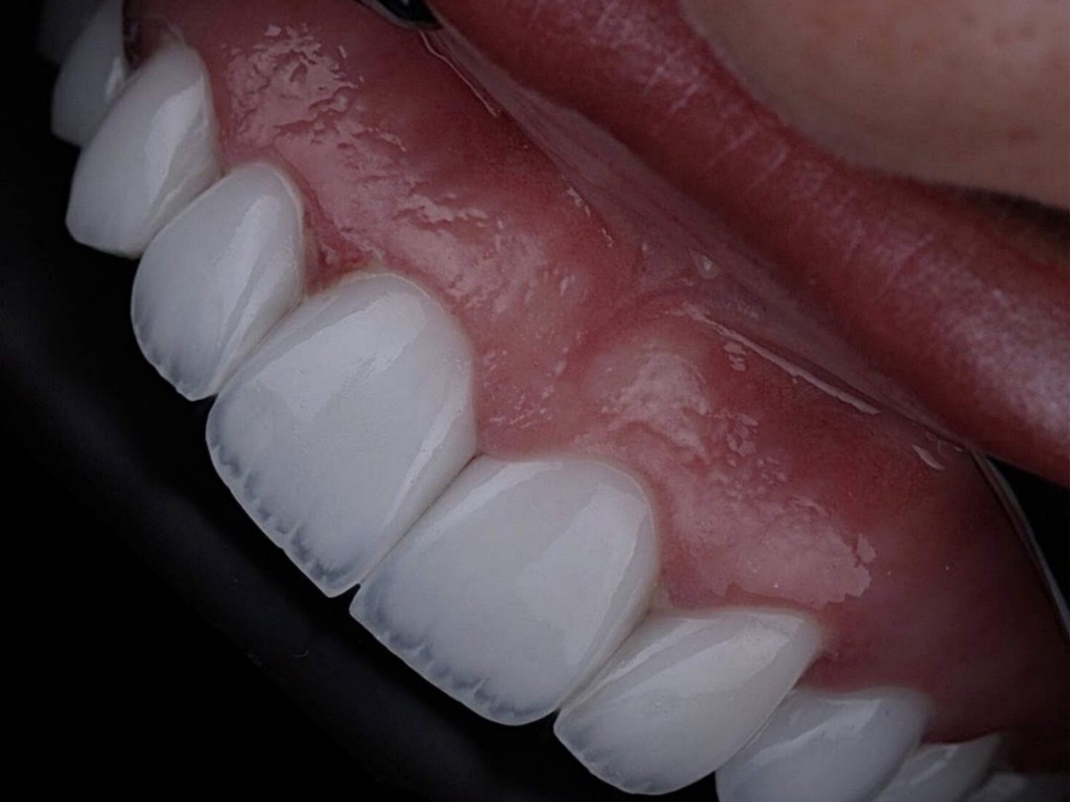 Smile Club Veneers premium veneer result